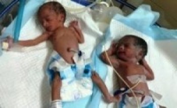 उडिरहेको विमान भित्र जुम्ल्याहा बालिकाको जन्म  