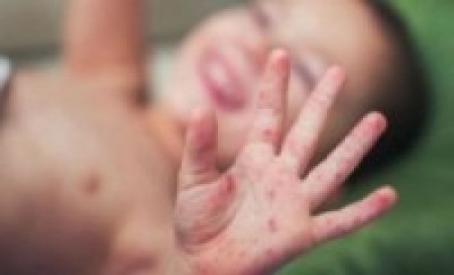 १६ जिल्लाका एक हजारभन्दा बढी दादुराबाट सङ्क्रमित  