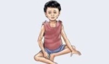 कुष्ठरोगबाट बालबालिका प्रभावित हुँदै