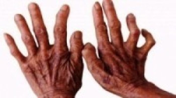 म्याग्दीमा कुष्ठरोगका नयाँ बिरामी देखिएन