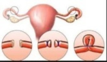 पाठेघर खस्ने समस्याको उपचारसम्बन्धी तालिम