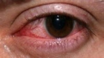 आँखा पाक्ने रोगमा ‘इन्टेरो भाइरस’ सङ्क्रमण धेरै