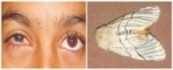 म्याग्दीका गाउँगाउँमा ‘सेतो पुतली झुस’ समस्या   