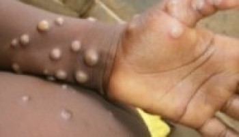 मङ्कीपक्स सङ्क्रमण पुनः देखियो