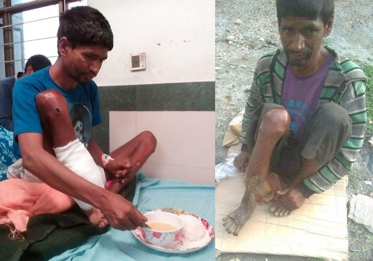 नेपाली साझा मंचको पहलमा करण कटि भुलको खुट्टाको अपरेसन सफल |